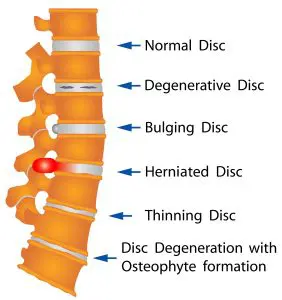 Spine Disc Disorder chart shows herniated disc, bulging disc, and degenerative disc disease