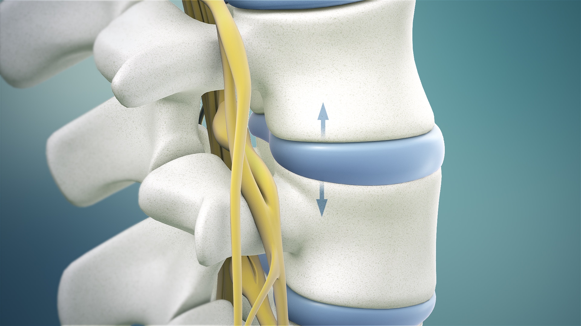 medical illustration of a disc in a spine during spinal decompression