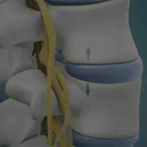 medical illustration of a disc in a spine