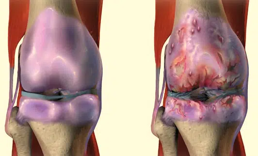 animated picture of Osteoarthritis