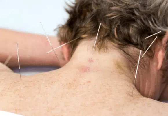 man undergoing acupuncture treatment for vertigo.