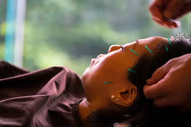 Acupuncture treatment for vertigo.