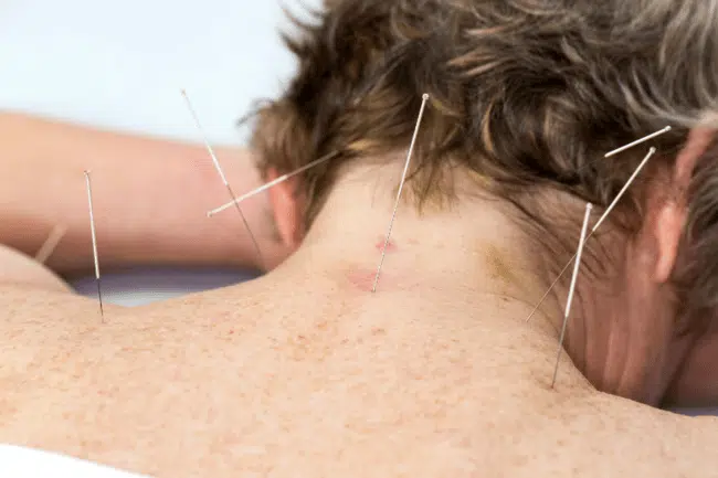 Acupuncture treatment for Dizziness