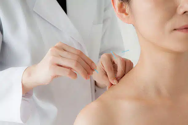 Women receiving acupuncture treatment