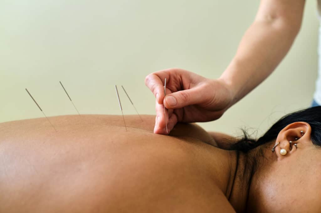 woman laying on her back receiving acupuncture treatment