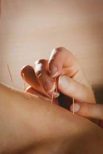 Experienced and Qualified Sugar Land Doctors carefully applying needles on patient's shoulder